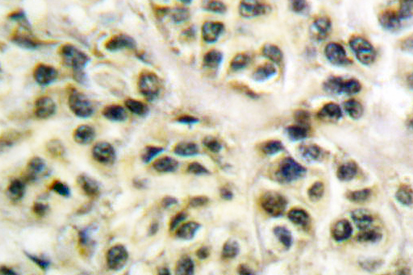IHC of Cyclin-L1 (E491) pAb in paraffin-embedded human breast carcinoma lung carcinoma tissue.