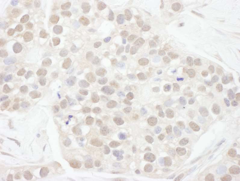 Detection of Human Cyclin T1 by Immunohistochemistry. Sample: FFPE section of human breast carcinoma. Antibody: Affinity purified rabbit anti-Cyclin T1 used at a dilution of 1:200 (1 ug/ml). Detection: DAB.