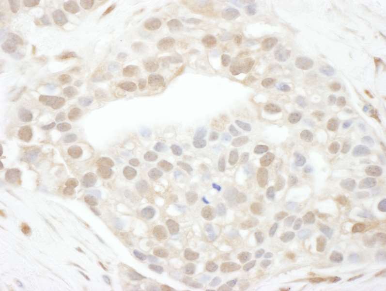 Detection of Human Cyclin T1 by Immunohistochemistry. Sample: FFPE section of human breast carcinoma. Antibody: Affinity purified rabbit anti-Cyclin T1 used at a dilution of 1:200 (1 ug/ml). Detection: DAB.