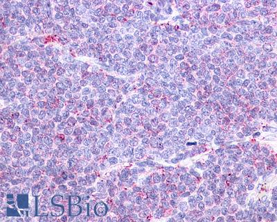 Anti-CCR10 / GPR2 antibody IHC of human Lymph Node, Non-Hodgkins Lymphoma. Immunohistochemistry of formalin-fixed, paraffin-embedded tissue after heat-induced antigen retrieval.