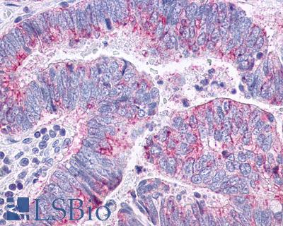 Anti-CCR10 / GPR2 antibody IHC of human Colon, Carcinoma. Immunohistochemistry of formalin-fixed, paraffin-embedded tissue after heat-induced antigen retrieval.