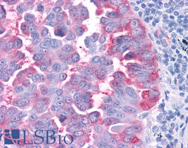 Anti-CCR4 antibody IHC of human Lung, Non-Small Cell Carcinoma. Immunohistochemistry of formalin-fixed, paraffin-embedded tissue after heat-induced antigen retrieval.