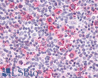 Anti-CCR9 antibody IHC of human Lymph Node, Hodgkins Lymphoma. Immunohistochemistry of formalin-fixed, paraffin-embedded tissue after heat-induced antigen retrieval.