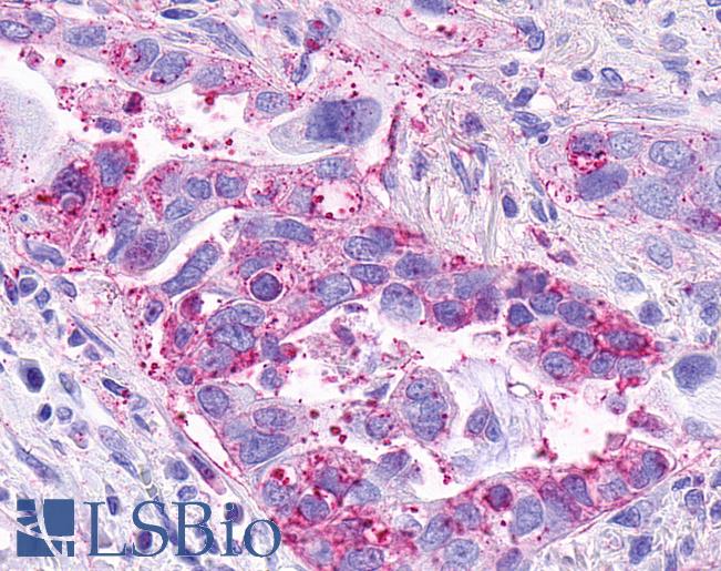 Anti-CCRL2 antibody IHC of human Lung, Adenocarcinoma. Immunohistochemistry of formalin-fixed, paraffin-embedded tissue after heat-induced antigen retrieval.