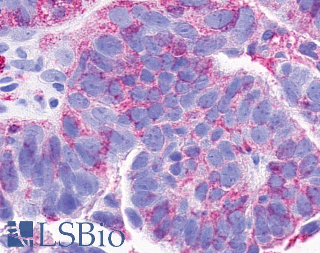 Anti-CCRL2 antibody IHC of human Ovary, Carcinoma. Immunohistochemistry of formalin-fixed, paraffin-embedded tissue after heat-induced antigen retrieval.