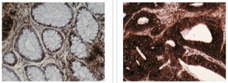 Left and Center: IHC of normal (left) and cancerous (center) colon tissue using TCP-1 antibody (LS-C27037). Right: Western blot of TCP-1 antibody on Calu6 (1) and HT-29 (2) cell lysates.