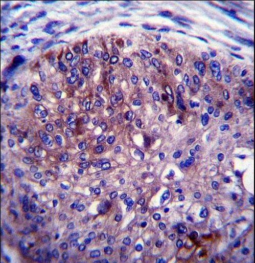 ADAL Antibody immunohistochemistry of formalin-fixed and paraffin-embedded human esophagus carcinoma followed by peroxidase-conjugated secondary antibody and DAB staining.