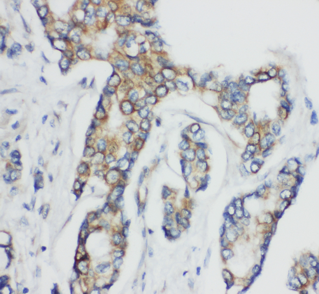 CD1D antibody. IHC(P): Human Breast Cancer Tissue.