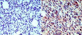 IHC of skin Langerin/CD207 in formalin-fixed, paraffin-embedded human (Langerhans cells) using antibody at 2.5 ug/ml. ?Hematoxylin-Eosin counterstain.
