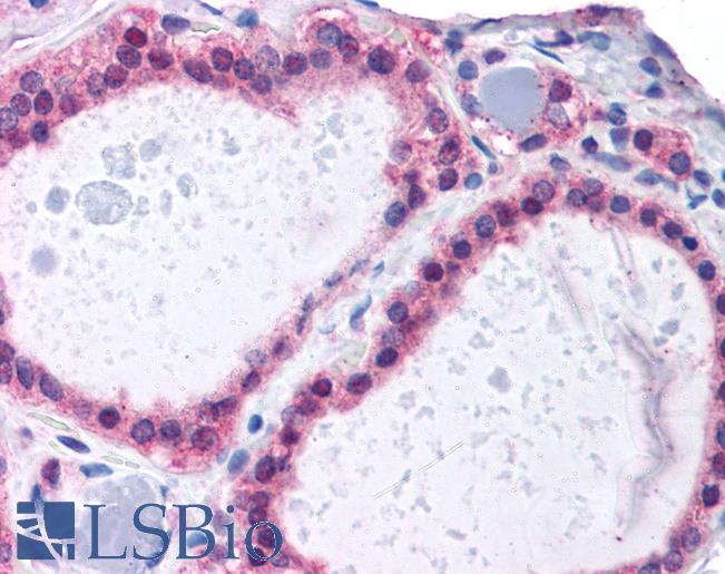 Anti-ADAM17 antibody IHC of human thyroid. Immunohistochemistry of formalin-fixed, paraffin-embedded tissue after heat-induced antigen retrieval. Antibody LS-B4437 concentration 3.75 ug/ml.