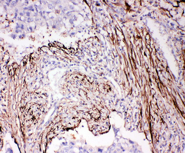 ADAM19 antibody. IHC(P): Human Lung Cancer Tissue.