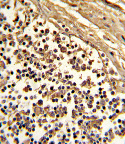 Formalin-fixed and paraffin-embedded human lymph with CD33 (SIGLEC3) Antibody , which was peroxidase-conjugated to the secondary antibody, followed by DAB staining. This data demonstrates the use of this antibody for immunohistochemistry; clinical relevance has not been evaluated.