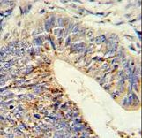 Formalin-fixed and paraffin-embedded human colon carcinoma reacted with ADAMDEC1 Antibody , which was peroxidase-conjugated to the secondary antibody, followed by DAB staining. This data demonstrates the use of this antibody for immunohistochemistry; clinical relevance has not been evaluated.