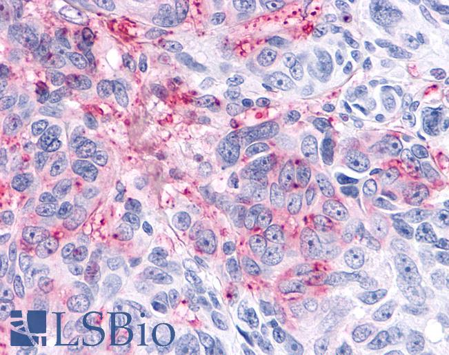 Anti-ADAMTS4 antibody IHC of human Skin, Melanoma. Immunohistochemistry of formalin-fixed, paraffin-embedded tissue after heat-induced antigen retrieval.