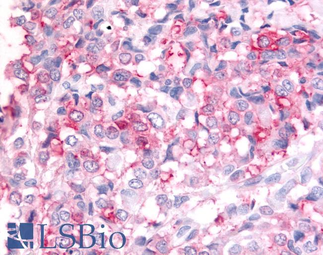 Anti-ADAMTS5 antibody IHC of human Breast, Carcinoma. Immunohistochemistry of formalin-fixed, paraffin-embedded tissue after heat-induced antigen retrieval.