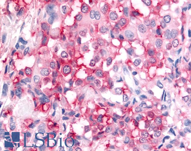 Anti-ADAMTS5 antibody IHC of human Breast, Carcinoma. Immunohistochemistry of formalin-fixed, paraffin-embedded tissue after heat-induced antigen retrieval.