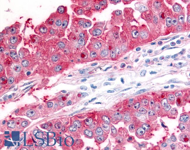 Anti-ADAMTS5 antibody IHC of human Lung, Non-Small Cell Carcinoma. Immunohistochemistry of formalin-fixed, paraffin-embedded tissue after heat-induced antigen retrieval.