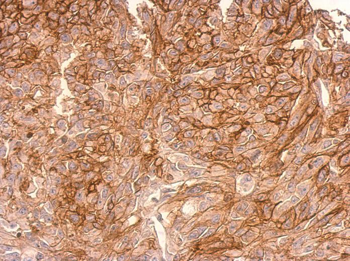 ADAMTSL2 antibody [C3], C-term detects ADAMTSL2 protein at cytosol (secreted) on SkHep1xenograft by immunohistochemical analysis. Sample: Paraffin-embedded SkHep1xenograft. ADAMTSL2 antibody [C3], C-term dilution:1:500.