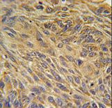 CD99L2 Antibody immunohistochemistry of formalin-fixed and paraffin-embedded human lung carcinoma followed by peroxidase-conjugated secondary antibody and DAB staining.