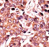 Formalin-fixed and paraffin-embedded human cancer tissue reacted with the primary antibody, which was peroxidase-conjugated to the secondary antibody, followed by AEC staining. This data demonstrates the use of this antibody for immunohistochemistry; clinical relevance has not been evaluated. BC = breast carcinoma; HC = hepatocarcinoma.