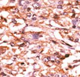 Formalin-fixed and paraffin-embedded human cancer tissue reacted with the primary antibody, which was peroxidase-conjugated to the secondary antibody, followed by AEC staining. This data demonstrates the use of this antibody for immunohistochemistry; clinical relevance has not been evaluated. BC = breast carcinoma; HC = hepatocarcinoma.