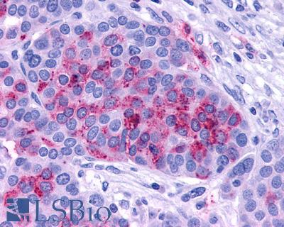 Anti-ADCYAP1R1 / PAC1 Receptor antibody IHC of human Ovary, Carcinoma. Immunohistochemistry of formalin-fixed, paraffin-embedded tissue after heat-induced antigen retrieval.