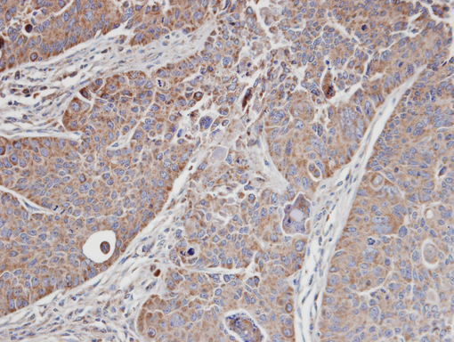 IHC of paraffin-embedded SW480 xenograft using MRCK alpha antibody at 1:100 dilution.