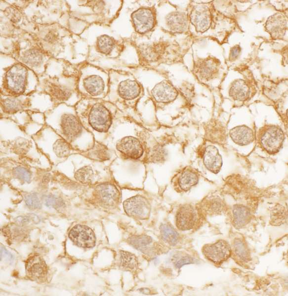 Detection of Human BORG4 by Immunohistochemistry. Sample: FFPE section of human testicular seminoma. Antibody: Affinity purified rabbit anti-BORG4 used at a dilution of 1:1000 (1 ug/ml). Detection: DAB.