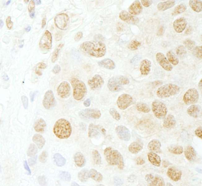 Detection of Human CDC5L by Immunohistochemistry. Sample: FFPE section of human breast carcinoma. Antibody: Affinity purified rabbit anti-CDC5L used at a dilution of 1:200 (1 ug/ml).