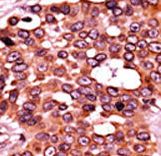 Formalin-fixed and paraffin-embedded human cancer tissue reacted with the primary antibody, which was peroxidase-conjugated to the secondary antibody, followed by AEC staining. This data demonstrates the use of this antibody for immunohistochemistry; clinical relevance has not been evaluated. BC = breast carcinoma; HC = hepatocarcinoma.