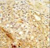 Formalin-fixed and paraffin-embedded human prostate carcinoma reacted with CDC73 Antibody , which was peroxidase-conjugated to the secondary antibody, followed by DAB staining. This data demonstrates the use of this antibody for immunohistochemistry; clinical relevance has not been evaluated.