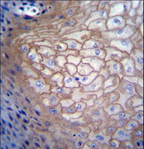 CDCA8 Antibody immunohistochemistry of formalin-fixed and paraffin-embedded human esophageal carcinoma followed by peroxidase-conjugated secondary antibody and DAB staining.