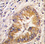 Formalin-fixed and paraffin-embedded human lung carcinoma tissue reacted with CDCA8 antibody , which was peroxidase-conjugated to the secondary antibody, followed by DAB staining. This data demonstrates the use of this antibody for immunohistochemistry; clinical relevance has not been evaluated.