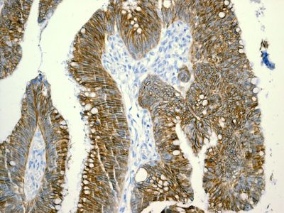 IHC of paraffin-embedded human colonic adenocarcinoma tissue using anti-LI-Cadherin antibody.