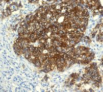 IHC of paraffin-embedded human colonic adenocarcinoma tissue using anti-LI-cadherin antibody.