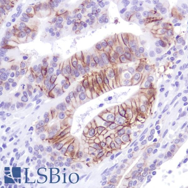 Immunohistochemistry of Human Stomach Adenocarcinoma stained with anti-Cadherin-17 antibody