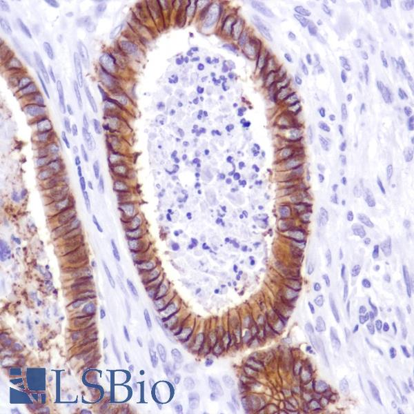 Immunohistochemistry of Human colon adenocarcinoma stained with anti-cadherin-17 antibody