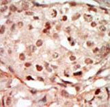 Formalin-fixed and paraffin-embedded human cancer tissue reacted with the primary antibody, which was peroxidase-conjugated to the secondary antibody, followed by DAB staining. This data demonstrates the use of this antibody for immunohistochemistry; clinical relevance has not been evaluated. BC = breast carcinoma; HC = hepatocarcinoma.