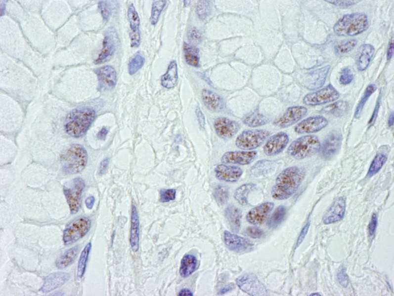 Detection of Human CDK11 by Immunohistochemistry. Sample: FFPE section of human stomach adenocarcinoma. Antibody: Affinity purified rabbit anti-CDK11 used at a dilution of 1:250. Detection: DAB.
