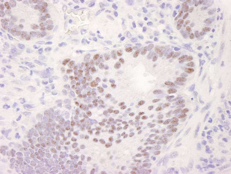 Detection of Human CDK11 by Immunohistochemistry. Sample: FFPE section of human stomach adenocarcinoma. Antibody: Affinity purified rabbit anti-CDK11 used at a dilution of 1:250. Detection: DAB.