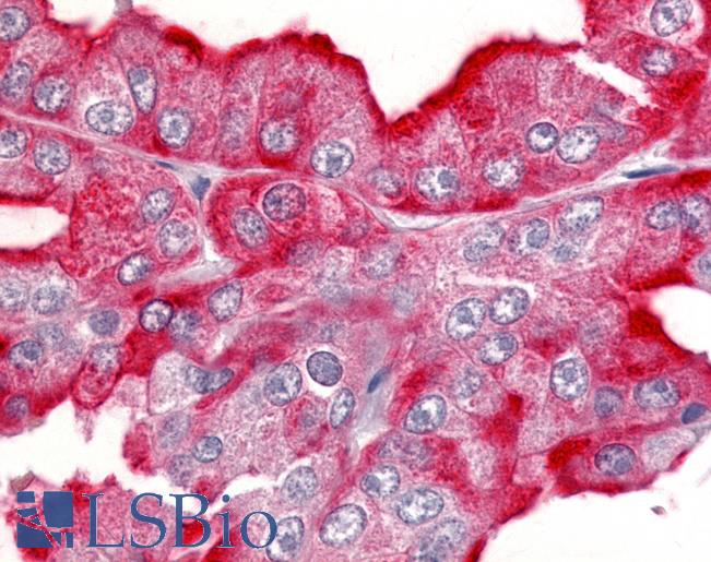 Anti-CDK12 / CRKRS antibody IHC of human Prostate, Carcinoma. Immunohistochemistry of formalin-fixed, paraffin-embedded tissue after heat-induced antigen retrieval.