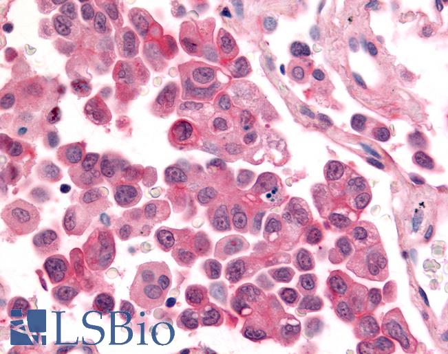Anti-CDK12 / CRKRS antibody IHC of human Lung, Non-Small Cell Carcinoma. Immunohistochemistry of formalin-fixed, paraffin-embedded tissue after heat-induced antigen retrieval.