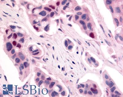 Anti-CDK12 / CRKRS antibody LS-A7350 IHC of human breast carcinoma. Immunohistochemistry of formalin-fixed, paraffin-embedded tissue after heat-induced antigen retrieval.