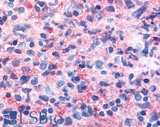 Anti-CDK12 / CRKRS antibody IHC of human Lymph Node, Non-Hodgkins Lymphoma. Immunohistochemistry of formalin-fixed, paraffin-embedded tissue after heat-induced antigen retrieval.