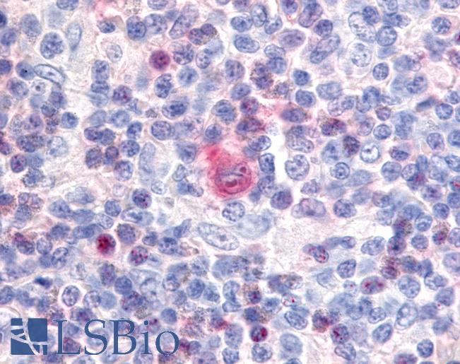 Anti-CDK12 / CRKRS antibody IHC of human Lymph Node, Hodgkins Lymphoma. Immunohistochemistry of formalin-fixed, paraffin-embedded tissue after heat-induced antigen retrieval.
