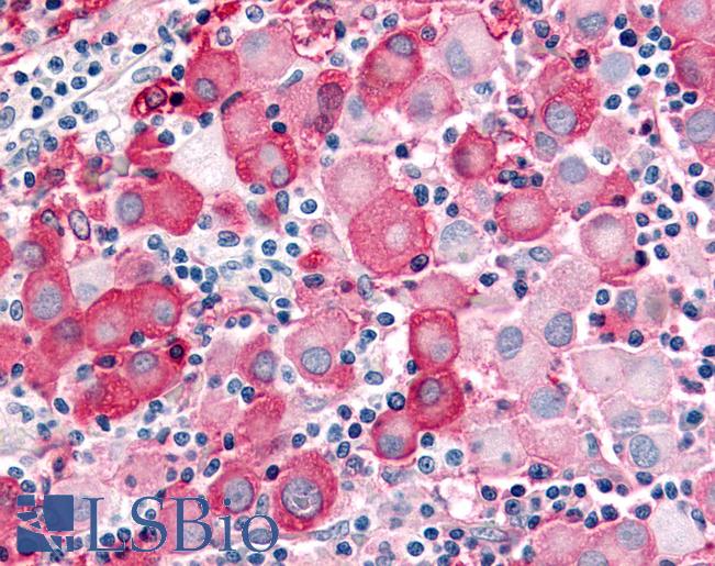 Anti-CDK12 / CRKRS antibody IHC of human Skin, Melanoma. Immunohistochemistry of formalin-fixed, paraffin-embedded tissue after heat-induced antigen retrieval.