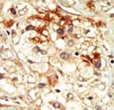 Formalin-fixed and paraffin-embedded human cancer tissue reacted with the primary antibody, which was peroxidase-conjugated to the secondary antibody, followed by DAB staining. This data demonstrates the use of this antibody for immunohistochemistry; clinical relevance has not been evaluated. BC = breast carcinoma; HC = hepatocarcinoma.