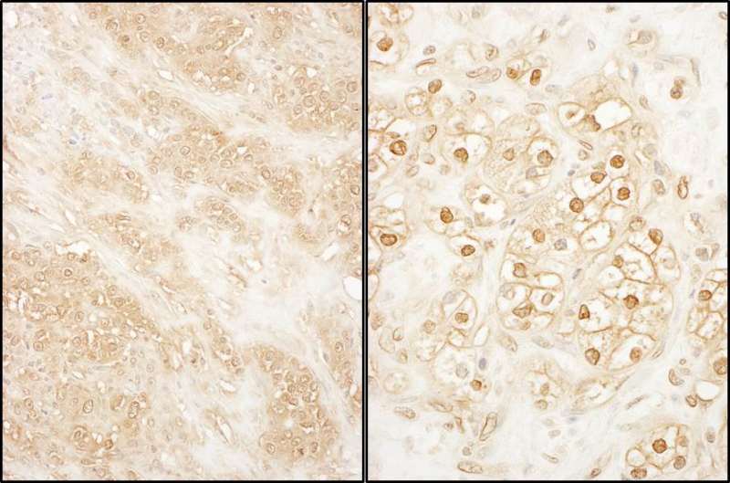 Detection of Human PCTAIRE 2 by Immunohistochemistry. Sample: FFPE section of human breast carcinoma (left) and kidney clear cell carcinoma (right). Antibody: Affinity purified rabbit anti-PCTAIRE 2 used at a dilution of 1:1000 (1 ug/ml). Detection: DAB.