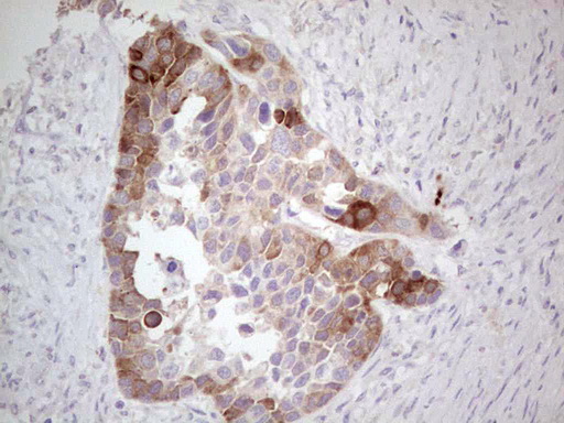 IHC of paraffin-embedded Carcinoma of Human kidney tissue using anti-CDKL1 mouse monoclonal antibody. (Heat-induced epitope retrieval by 1 mM EDTA in 10mM Tris, pH8.5, 120°C for 3min).