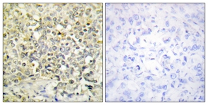 IHC of paraffin-embedded human lung carcinoma tissue, using CDKL4 Antibody. The picture on the right is treated with the synthesized peptide.
